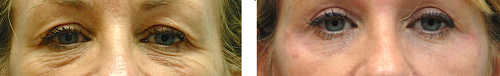Photo avant apres blepharoplastie Tunisie