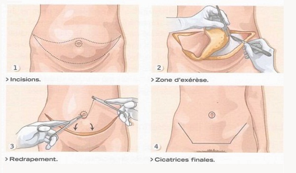 Deroulement abdominoplastie Tunisie