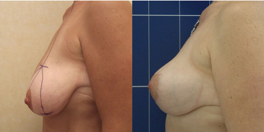 Lifting seins Tunisie: Photos avant apres