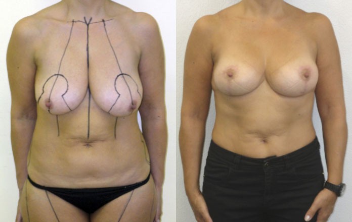 Lifting seins photo avant apres