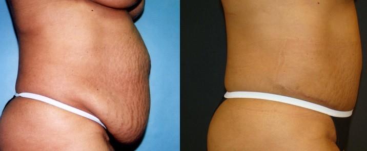 abdominoplastie Tunisie
