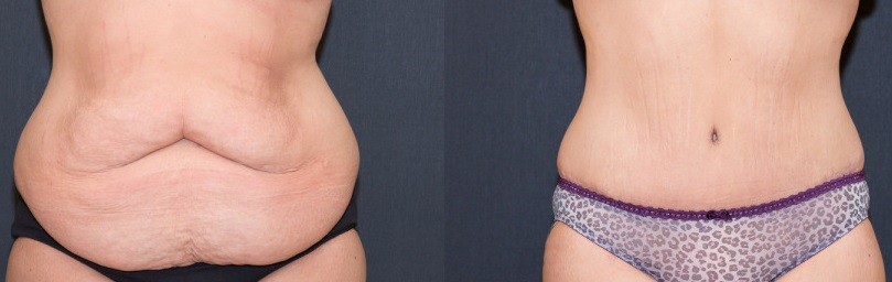 abdominoplastie Tunisie: photo avant-apres