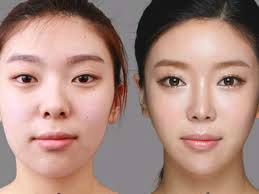 Blepharoplastie Tunisie pour qui