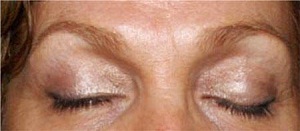 Cicatrice apres blepharoplastie Tunisie
