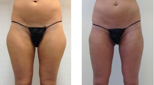 Resultat liposuccion Tunisie