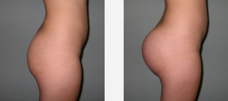 augmentation-fesses-implant