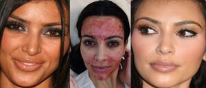 resultat-vampire-lift-Kim-K