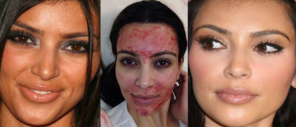 resultat-vampire-lift-Kim-K