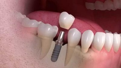 implant-dentaire-Turquie