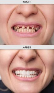 résultat-implant-dentaire-Turquie