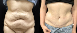 resultat-abdominoplastie-avant-apres