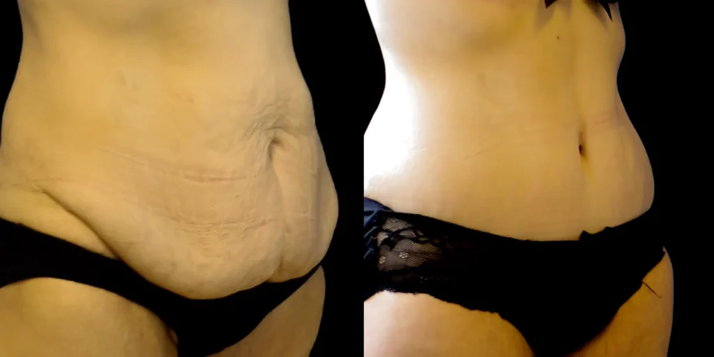 resultat-abdominoplastie-circulaire-avant-apres